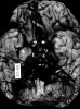 Subarachnoid hemorrhage, base of brain